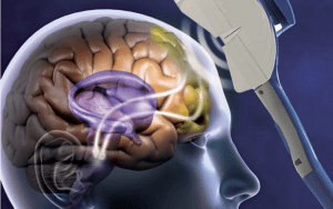 tms transcranial magnetic stimulation cognition