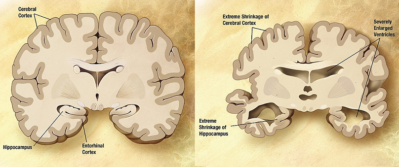 neuronal degeneration diseases