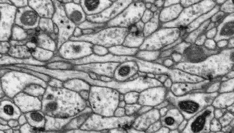 causes of neuronal darkening