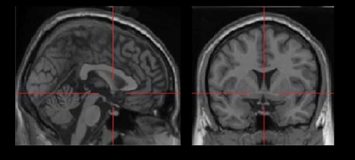 anterior commissure physiological role