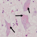neuronal ceroid lipofuscinosis ncl