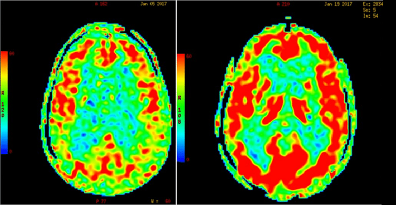 cerebral blood flow factors