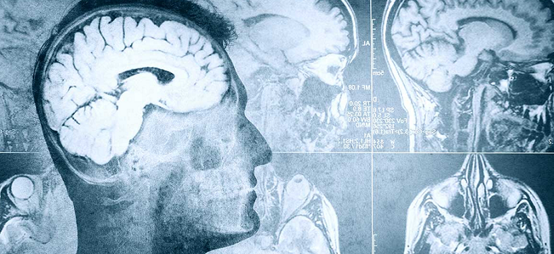 subgenual anterior cingulate cortex sgacc