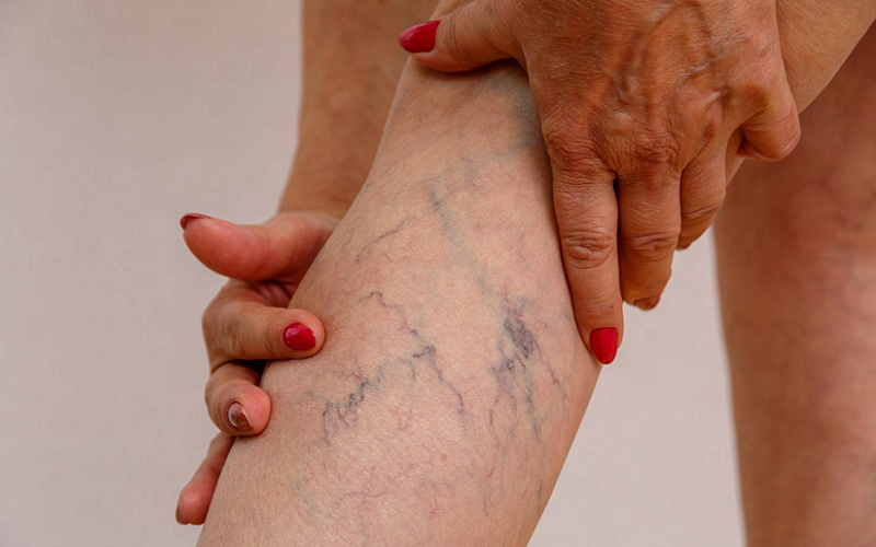 varicose veins brain health correlation