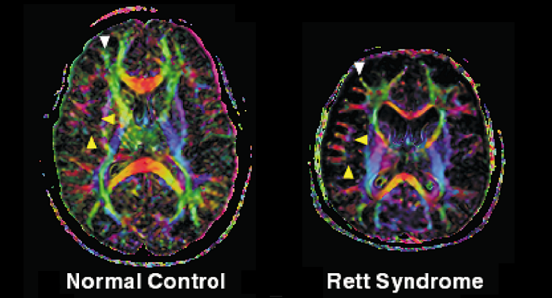 rett syndrome neural development